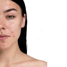 ACNE RELIEF BOOTCAMP at AESTHETICSBYNATALY in Alhambra, CA